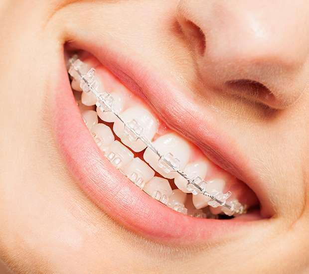 San Clemente Clear Braces