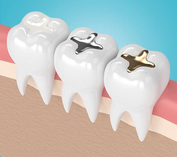 San Clemente Composite Fillings