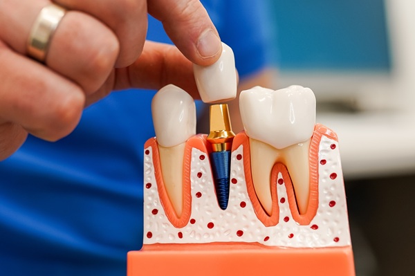 Can A Dental Implant Fall Out?