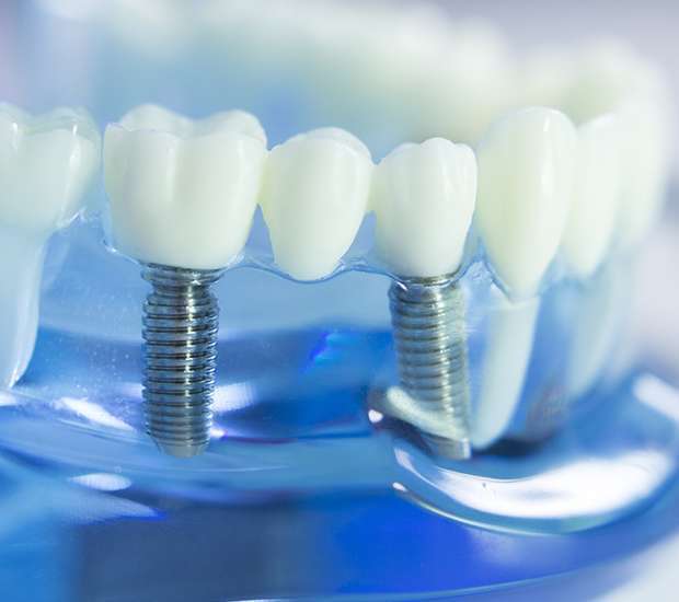 San Clemente Dental Implants