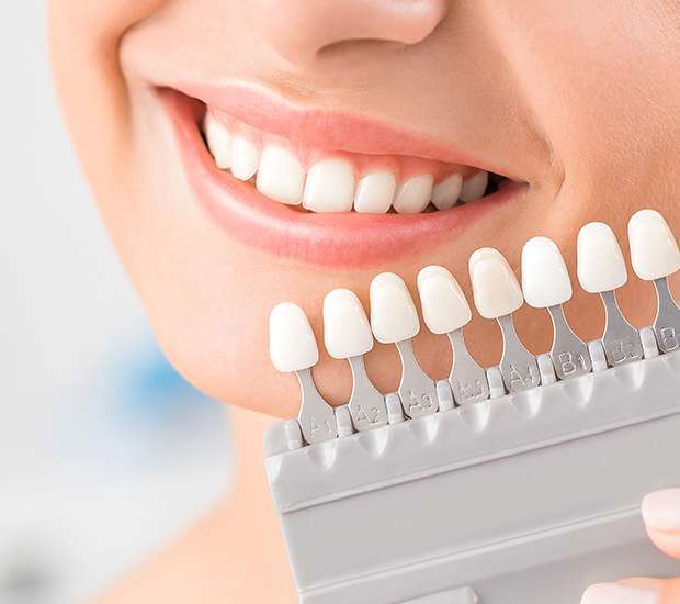 San Clemente Dental Veneers and Dental Laminates