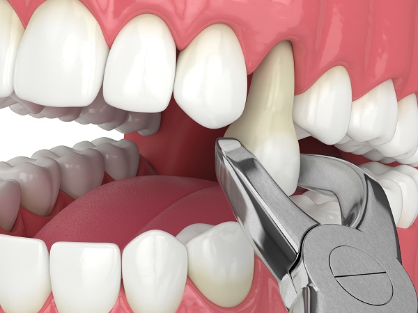 Tooth Extraction San Clemente, CA