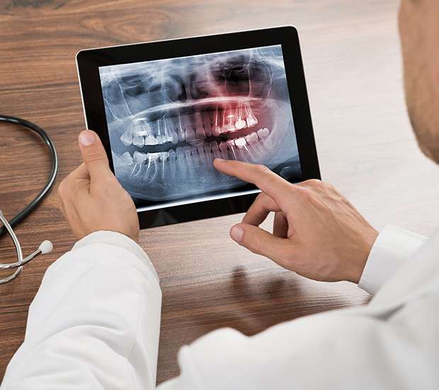 San Clemente Types of Dental Root Fractures
